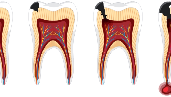 Apa Itu Gigi Berlubang? Gejala, Penyebab, dan Pengobatan